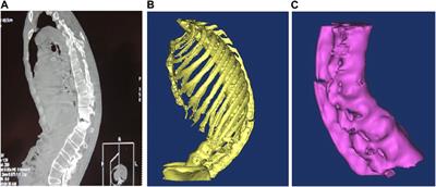 A case report on digital preoperative design, clinical application and finite element analysis for a patient with ankylosing spondylitis kyphosis